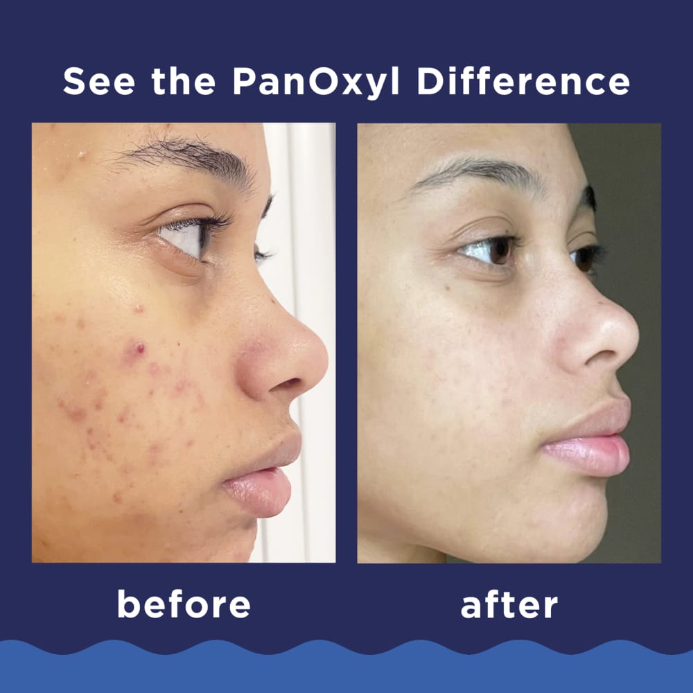 PanOxyl Acne Foaming Wash 85g