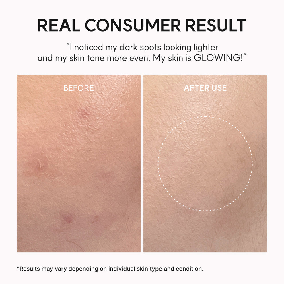 Arencia TXA Booster Shot, Intensive Dark Spot Correcting Serum with 5% TXA, Niacinamide & 10 Peptides for Visible Tone Correction & Radiant-Looking Skin 30 ml