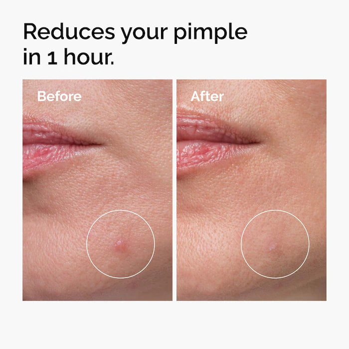 The Ordinary 
Sulfur 10% Powder-to-Cream Concentrate Acne Spot Treatment